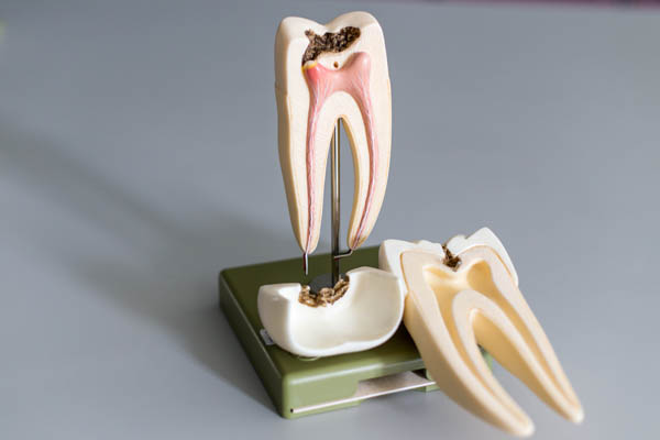 The FAQs Of Root Canal Treatment